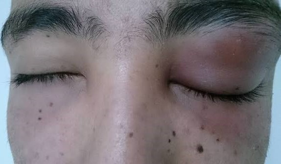 ALERTA NA BAIXADA: HOSPITAIS E UPAS JÁ RECEBEM PACIENTES COM OLHOS INCHADOS E INFLAMADOS
